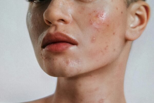 "Effective Ways to Treat Acne on Face"