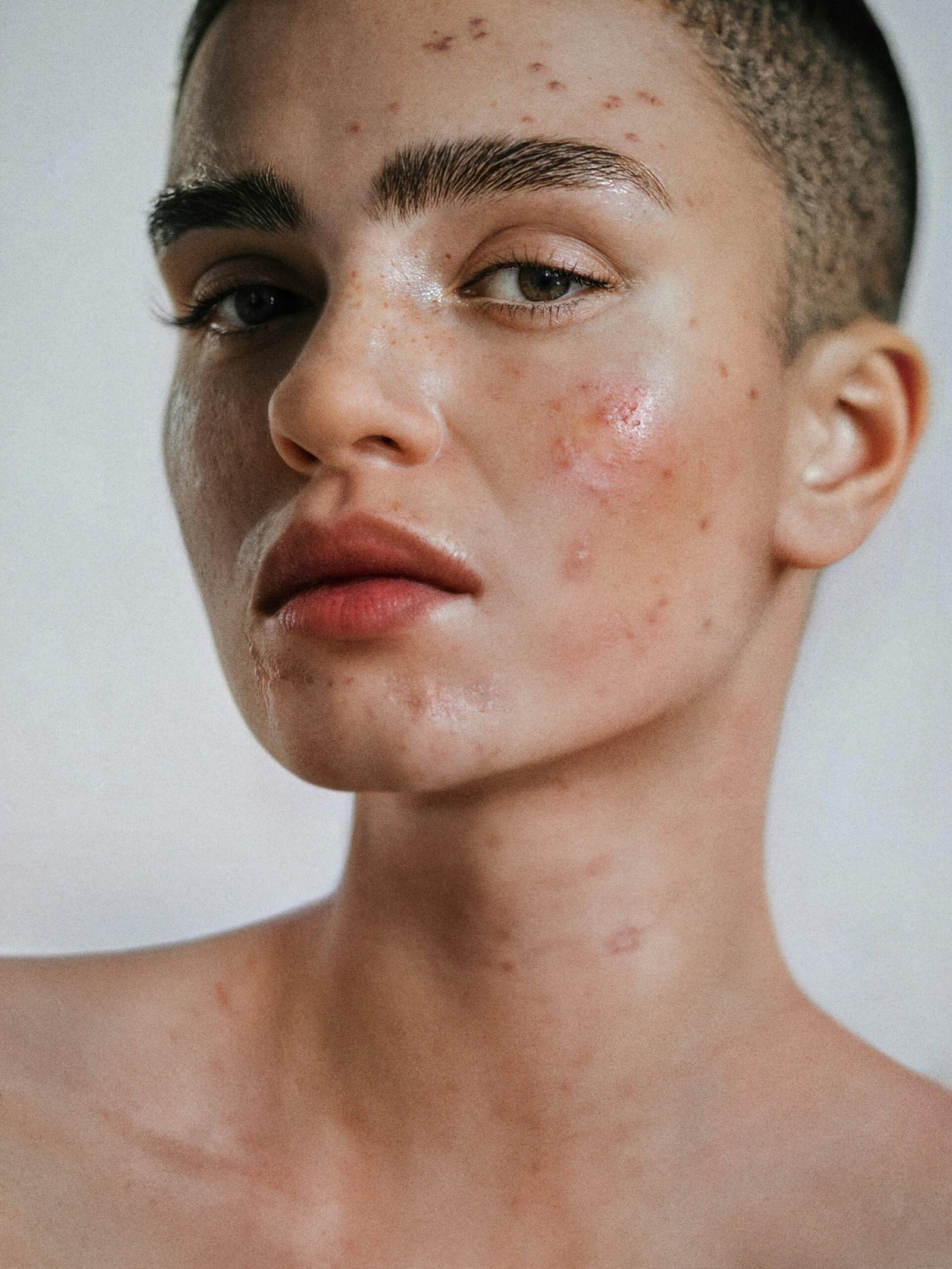 "Effective Ways to Treat Acne on Face"